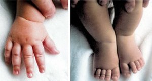 TS baby's hand and feet with lymphoedema